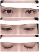 二重埋没 湘南美容クリニック 仙台院 DAY 9 サムネイル用