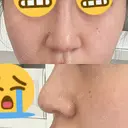 鼻尖形成（切開） / 鼻尖縮小 / その他（鼻） 聖心美容クリニック 札幌院 AFTER サムネイル用