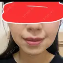 ボトックス（エラ・小顔） あいちビューティークリニック DAY 3 サムネイル用