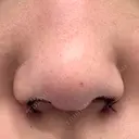 鼻孔縁挙上 GLANZ CLINIC DAY 0 サムネイル用