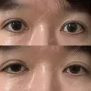 二重埋没 水の森美容クリニック 東京新宿院 AFTER サムネイル用