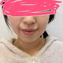 ボトックス（エラ・小顔） あいちビューティークリニック DAY 6 サムネイル用