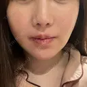 鼻翼基部形成（貴族手術） 新宿ラクル美容外科クリニック 新宿院 AFTER サムネイル用