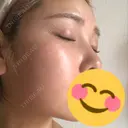 毛穴洗浄（ハイドラフェイシャルなど） / ピーリング（ハリ・ツヤ） / ミラノリピール Casa de GRACIA GINZA 【カーサデグラシアギンザ】 DAY 1 サムネイル用