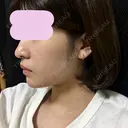 あごプロテーゼ 恵聖会クリニック 京橋院 DAY 39 サムネイル用