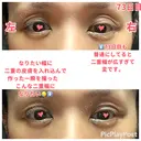 二重切開 / 眼瞼下垂（切開） / 上まぶたたるみ取り 心斎橋形成外科スキンケアクリニック DAY 73 サムネイル用