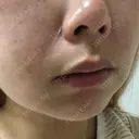 毛穴洗浄（ハイドラフェイシャルなど） / ピーリング（ハリ・ツヤ） / ミラノリピール Casa de GRACIA GINZA 【カーサデグラシアギンザ】 DAY 3 サムネイル用