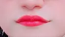 ヒアルロン酸注入（唇） / ボトックス（口角） ブルームクリニック（BLOOM CLINIC） AFTER サムネイル用
