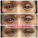二重切開 / 眼瞼下垂（切開） / 上まぶたたるみ取り 心斎橋形成外科スキンケアクリニック DAY 73 サムネイル用