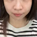 ヒアルロン酸注入（頬） 心斎橋形成外科スキンケアクリニック AFTER サムネイル用