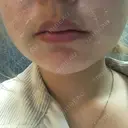 毛穴洗浄（ハイドラフェイシャルなど） / ピーリング（ハリ・ツヤ） / ミラノリピール Casa de GRACIA GINZA 【カーサデグラシアギンザ】 DAY 4 サムネイル用