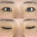 二重埋没 湘南美容クリニック 大阪心斎橋院 AFTER サムネイル用