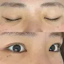 二重埋没 湘南美容クリニック 大阪心斎橋院 DAY 134 サムネイル用