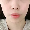 ヒアルロン酸注入（あご） ASTRA BEAUTY CLINIC AFTER サムネイル用