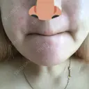 毛穴洗浄（ハイドラフェイシャルなど） / ピーリング（ハリ・ツヤ） / ミラノリピール Casa de GRACIA GINZA 【カーサデグラシアギンザ】 DAY 5 サムネイル用