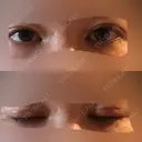 眼瞼下垂（切開） 十仁美容整形 DAY 23 サムネイル用