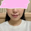 ボトックス（エラ・小顔） あいちビューティークリニック DAY 10 サムネイル用