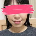 ボトックス（エラ・小顔） あいちビューティークリニック AFTER サムネイル用