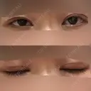 眼瞼下垂（切開） 十仁美容整形 DAY 24 サムネイル用