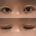 眼瞼下垂（切開） 十仁美容整形 DAY 25 サムネイル用