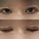 眼瞼下垂（切開） 十仁美容整形 DAY 26 サムネイル用