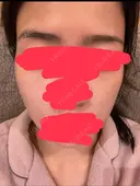 シミ取りレーザー CLINICA BellaForma DAY 3 サムネイル用