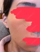 シミ取りレーザー CLINICA BellaForma DAY 3 サムネイル用