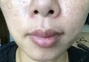 ボトックス（あご） / ボトックス（エラ・小顔） / ボトックス（目尻） TCB東京中央美容外科 新宿三丁目院 DAY 17 サムネイル用