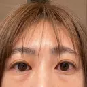 クマ治療 / 脂肪注入（目の下） / その他（目元） セオリークリニック DAY 59 サムネイル用