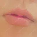ヒアルロン酸注入（唇） / ボトックス（口角） グランメドクリニック茨木 AFTER サムネイル用