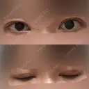 眼瞼下垂（切開） 十仁美容整形 DAY 28 サムネイル用