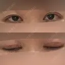 眼瞼下垂（切開） 十仁美容整形 DAY 29 サムネイル用