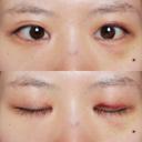 目頭切開 / 目尻切開 / 水光注射（ハリ・美肌） エートップ美容整形外科 DAY 13 サムネイル用