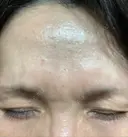 ボトックス（眉間） / ボトックス（人中） TCB東京中央美容外科 高田馬場院 DAY 0 サムネイル用