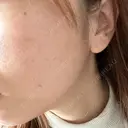 ピコフラクショナルレーザー（毛穴・ニキビ跡） CLINICA BellaForma AFTER サムネイル用