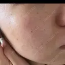 ピコフラクショナルレーザー（毛穴・ニキビ跡） CLINICA BellaForma DAY 35 サムネイル用