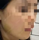 ボトックス（エラ・小顔） TCB東京中央美容外科 上野院 DAY 8 サムネイル用