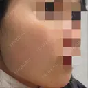 ボトックス（エラ・小顔） TCB東京中央美容外科 上野院 AFTER サムネイル用