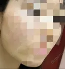 ボトックス（エラ・小顔） TCB東京中央美容外科 上野院 DAY 15 サムネイル用