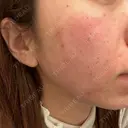 ピコフラクショナルレーザー（毛穴・ニキビ跡） CLINICA BellaForma DAY 0 サムネイル用