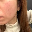 ピコフラクショナルレーザー（毛穴・ニキビ跡） CLINICA BellaForma DAY 0 サムネイル用