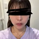 肌ヒアルロン酸注入（たるみ・シワ改善） / ヒアルロン酸注入（あご） / ボトックス（エラ・小顔） LE CLINIC DAY 1 サムネイル用