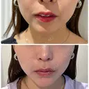 肌ヒアルロン酸注入（たるみ・シワ改善） / ヒアルロン酸注入（あご） / ボトックス（エラ・小顔） LE CLINIC AFTER サムネイル用