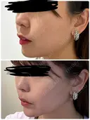 肌ヒアルロン酸注入（たるみ・シワ改善） / ヒアルロン酸注入（あご） / ボトックス（エラ・小顔） LE CLINIC DAY 1 サムネイル用