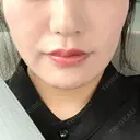 糸リフト / バッカルファット除去 / 脂肪吸引（顔） 湘南美容クリニック 京都院 DAY 169 サムネイル用