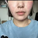 糸リフト / バッカルファット除去 / 脂肪吸引（顔） 湘南美容クリニック 京都院 DAY 169 サムネイル用