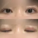 眼瞼下垂（切開） 十仁美容整形 DAY 35 サムネイル用