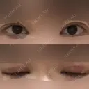 眼瞼下垂（切開） 十仁美容整形 AFTER サムネイル用