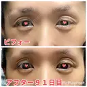 二重切開 / 眼瞼下垂（切開） / 上まぶたたるみ取り 心斎橋形成外科スキンケアクリニック DAY 91 サムネイル用