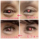 二重切開 / 眼瞼下垂（切開） / 上まぶたたるみ取り 心斎橋形成外科スキンケアクリニック DAY 91 サムネイル用